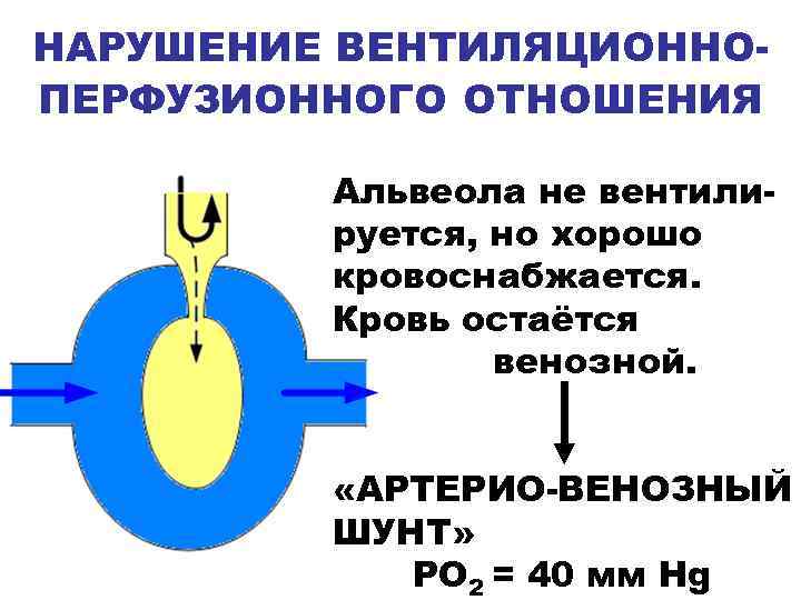 НАРУШЕНИЕ ВЕНТИЛЯЦИОННОПЕРФУЗИОННОГО ОТНОШЕНИЯ Альвеола не вентилируется, но хорошо кровоснабжается. Кровь остаётся венозной. «АРТЕРИО-ВЕНОЗНЫЙ ШУНТ»