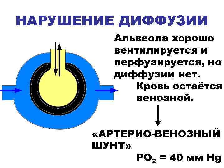 НАРУШЕНИЕ ДИФФУЗИИ Альвеола хорошо вентилируется и перфузируется, но диффузии нет. Кровь остаётся венозной. «АРТЕРИО-ВЕНОЗНЫЙ