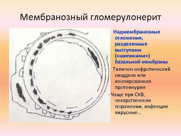 Мембранозный гломерулонерит Надмембранозные отложения, разделенные выступами ( «шипиками» ) базальной мембраны Типичен нефротический синдром