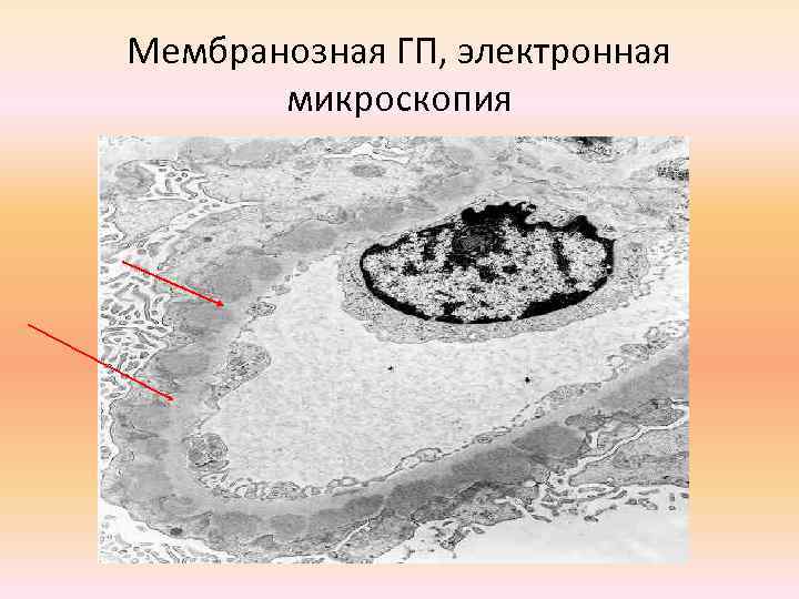 Мембранозная ГП, электронная микроскопия 