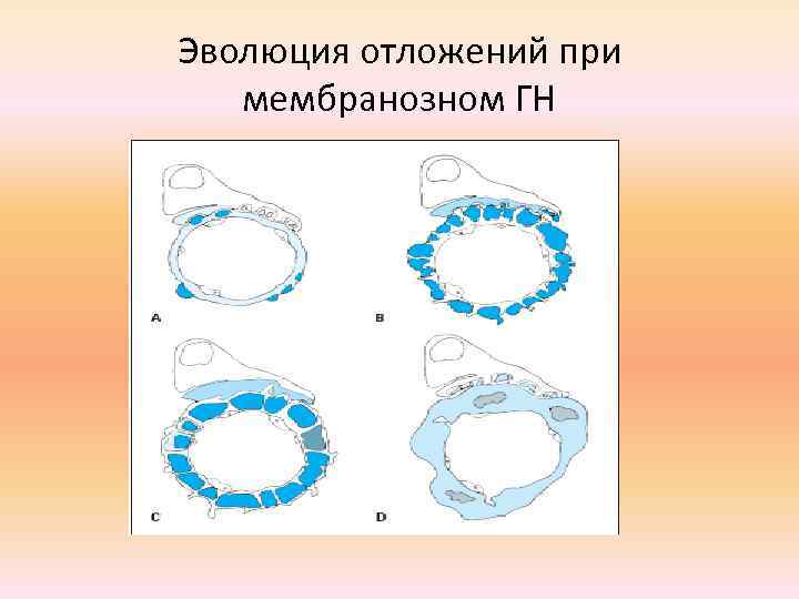 Эволюция отложений при мембранозном ГН 