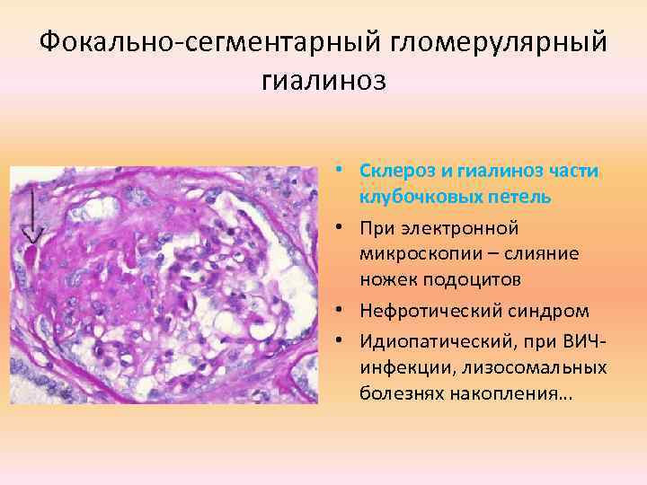Фокально-сегментарный гломерулярный гиалиноз • Склероз и гиалиноз части клубочковых петель • При электронной микроскопии