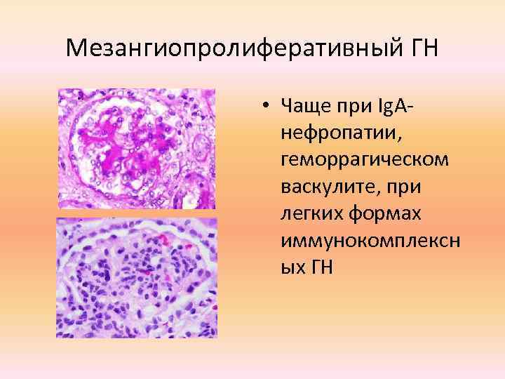 Мезангиопролиферативный ГН • Чаще при Ig. Aнефропатии, геморрагическом васкулите, при легких формах иммунокомплексн ых