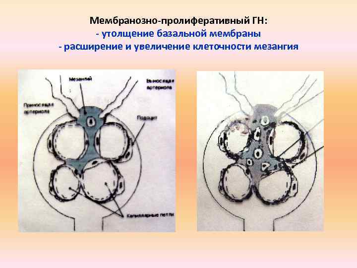 Мембранозно-пролиферативный ГН: - утолщение базальной мембраны - расширение и увеличение клеточности мезангия 