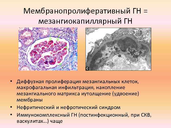 Мембранопролиферативный ГН = мезангиокапиллярный ГН • Диффузная пролиферация мезангиальных клеток, макрофагальная инфильтрация, накопление мезангиального