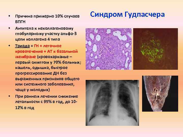  • • Причина примерно 10% случаев БПГН Антитела к неколлагеновому глобулярному участку альфа-3