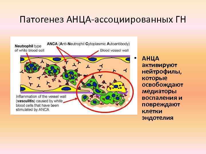Патогенез АНЦА-ассоциированных ГН • АНЦА активируют нейтрофилы, которые освобождают медиаторы воспаления и повреждают клетки