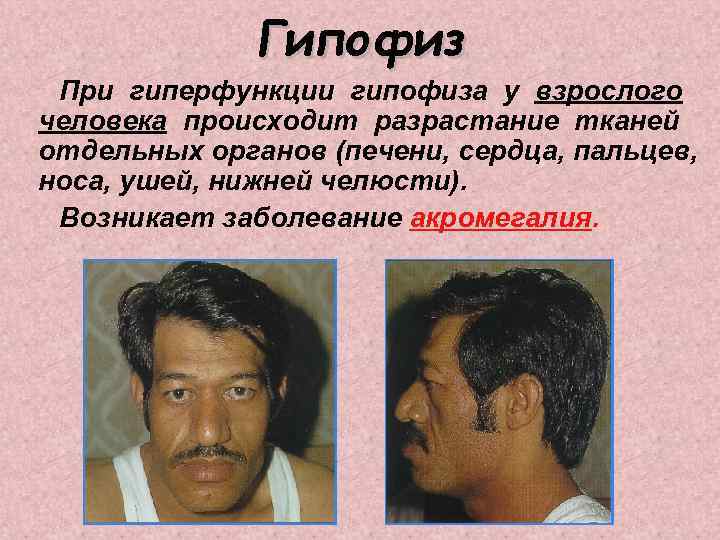 Гипофиз При гиперфункции гипофиза у взрослого человека происходит разрастание тканей отдельных органов (печени, сердца,