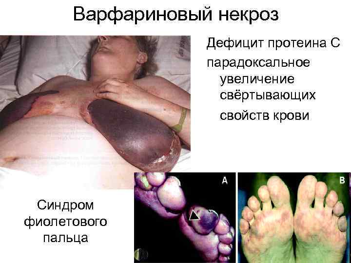Варфариновый некроз Дефицит протеина С парадоксальное увеличение свёртывающих свойств крови Синдром фиолетового пальца 
