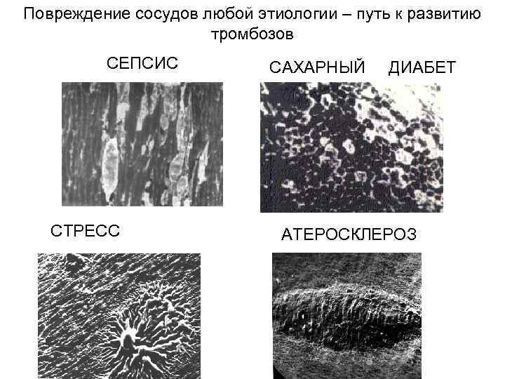 Повреждение сосудов любой этиологии – путь к развитию тромбозов СЕПСИС СТРЕСС САХАРНЫЙ ДИАБЕТ АТЕРОСКЛЕРОЗ