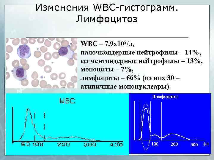 Изменения WBC-гистограмм. Лимфоцитоз WBC – 7, 9 х109/л, палочкоядерные нейтрофилы – 14%, сегментоядерные нейтрофилы