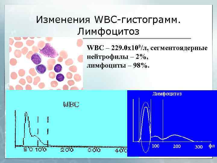Изменения WBC-гистограмм. Лимфоцитоз WBC – 229. 0 х109/л, сегментоядерные нейтрофилы – 2%, лимфоциты –