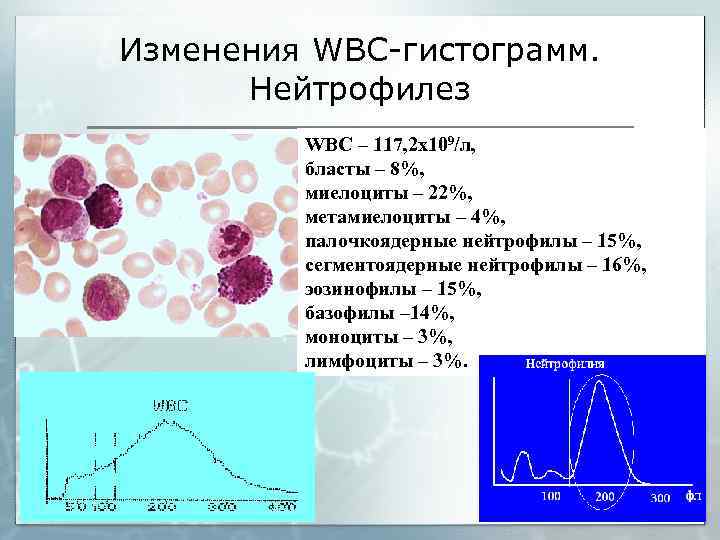 Изменения WBC-гистограмм. Нейтрофилез WBC – 117, 2 х109/л, бласты – 8%, миелоциты – 22%,