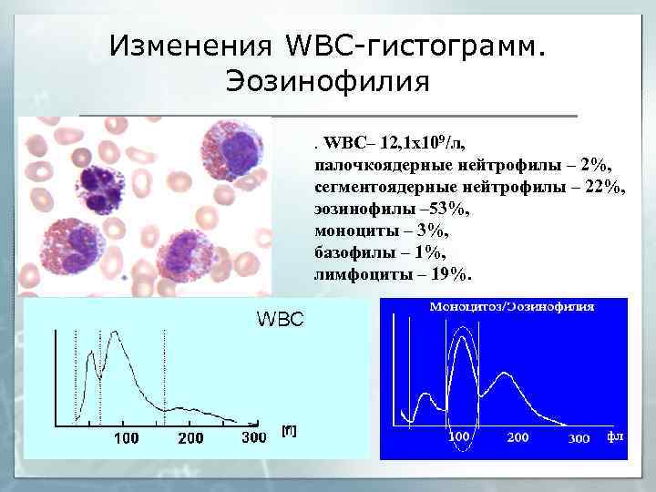 Изменения WBC-гистограмм. Эозинофилия. WBC– 12, 1 х109/л, палочкоядерные нейтрофилы – 2%, сегментоядерные нейтрофилы –