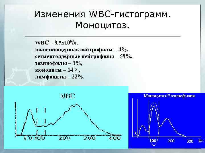 Изменения WBC-гистограмм. Моноцитоз. WBC – 9, 5 х109/л, палочкоядерные нейтрофилы – 4%, сегментоядерные нейтрофилы