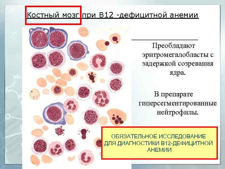 Клинические рекомендации б12 анемия. Б12 дефицитная анемия нейтрофилы. Лабораторные исследования анемии при в12.