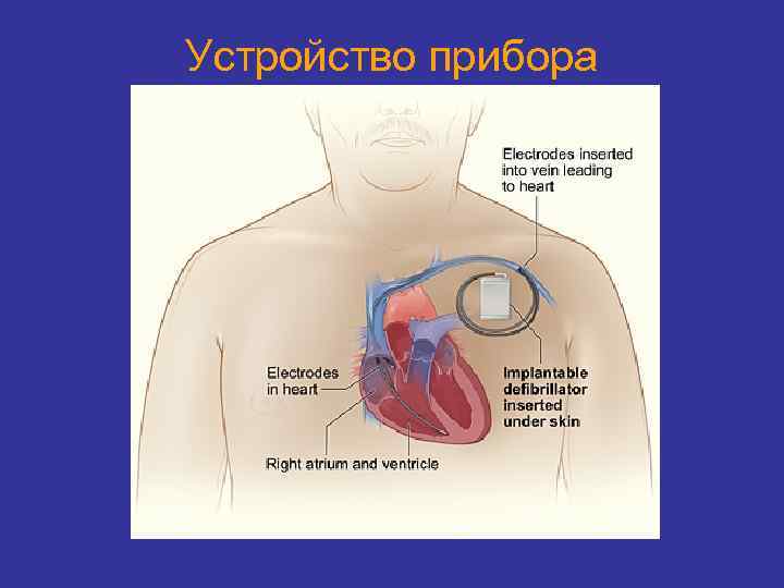 Устройство прибора 