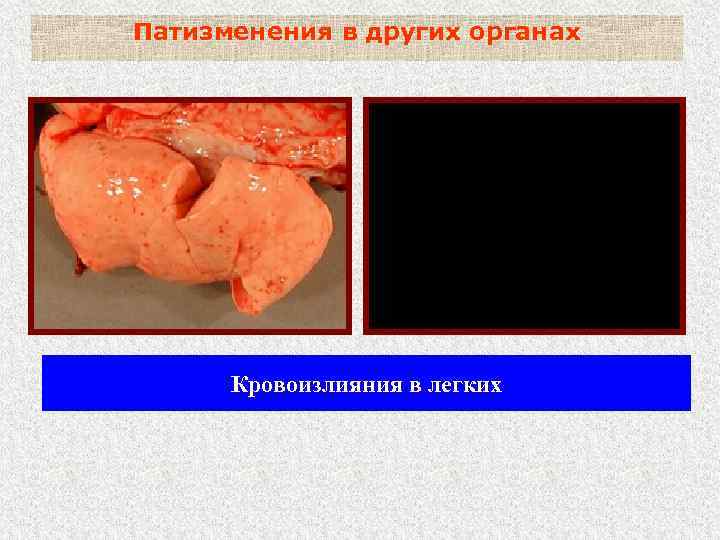 Патизменения в других органах Кровоизлияния в легких 
