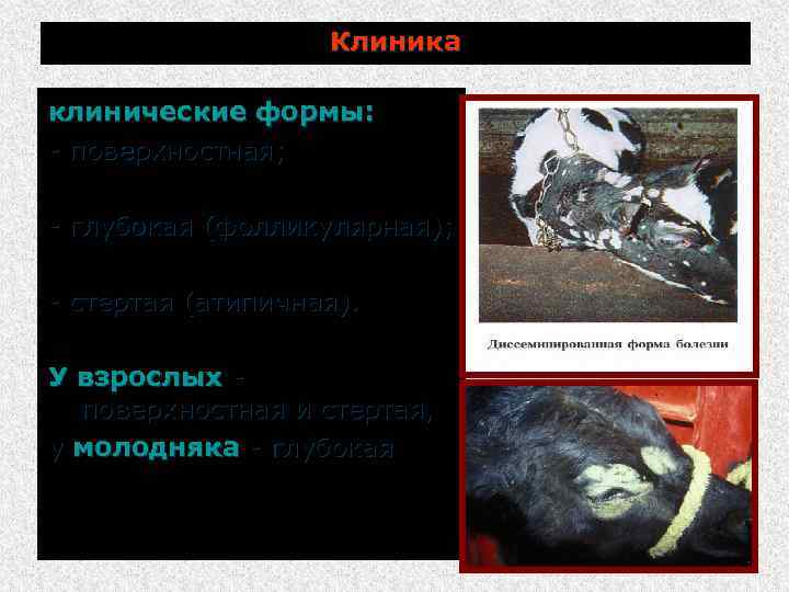 Клиника клинические формы: поверхностная; глубокая (фолликулярная); стертая (атипичная). У взрослых поверхностная и стертая, у