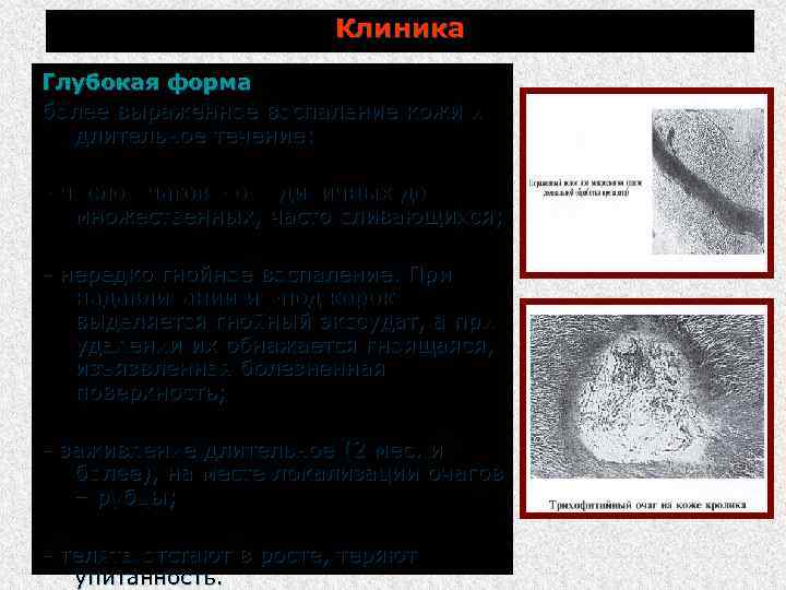 Клиника Глубокая форма более выраженное воспаление кожи и длительное течение: число очагов от единичных