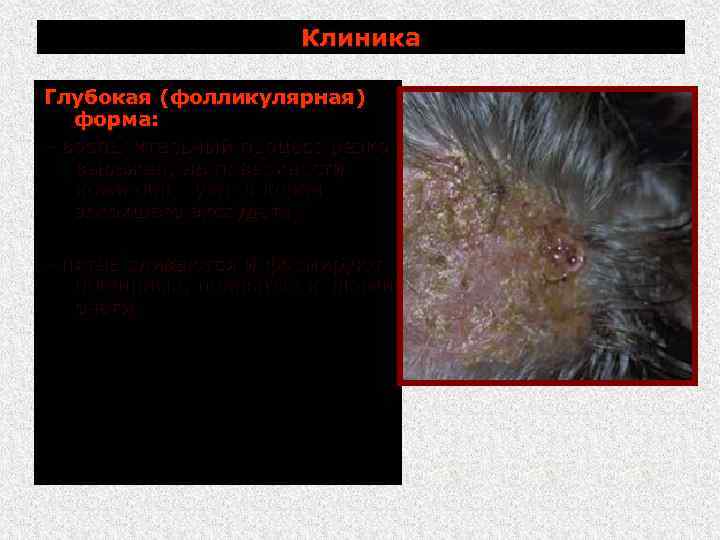 Клиника Глубокая (фолликулярная) форма: воспалительный процесс резко выражен, на поверхности кожи образуются корки засохшего