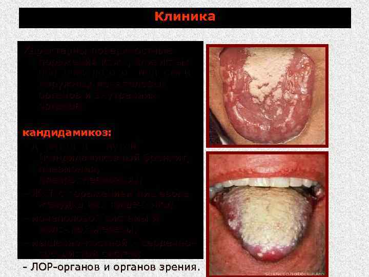 Клиника Характерны поверхностные поражения кожи, слизистых оболочек ротовой полости и наружных мочеполовых органов и