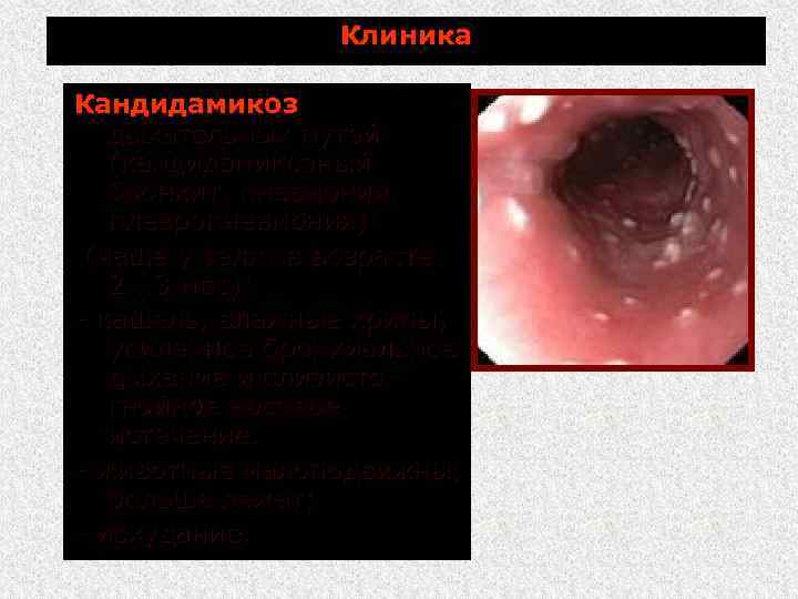 Клиника Кандидамикоз дыхательных путей (кандидамикозный бронхит, пневмония, плевропневмония) (чаще у телят в возрасте 2.