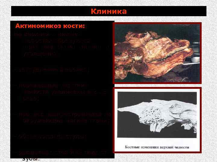 Клиника Актиномикоз кости: На верхней и нижней челюстях образуются неподвижные болезненные утолщения: затруднение жевания;