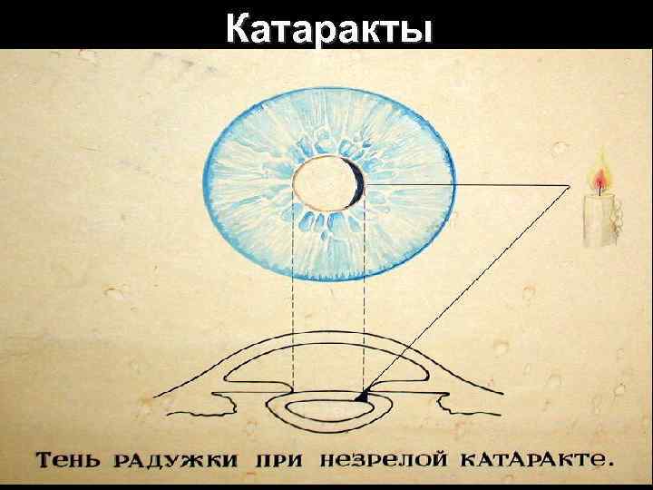 Катаракты 