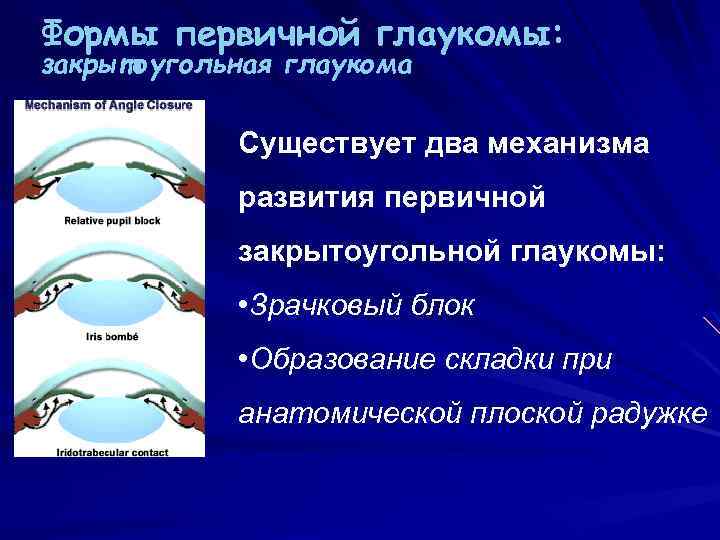 Формы первичной глаукомы: закрытоугольная глаукома Существует два механизма развития первичной закрытоугольной глаукомы: • Зрачковый