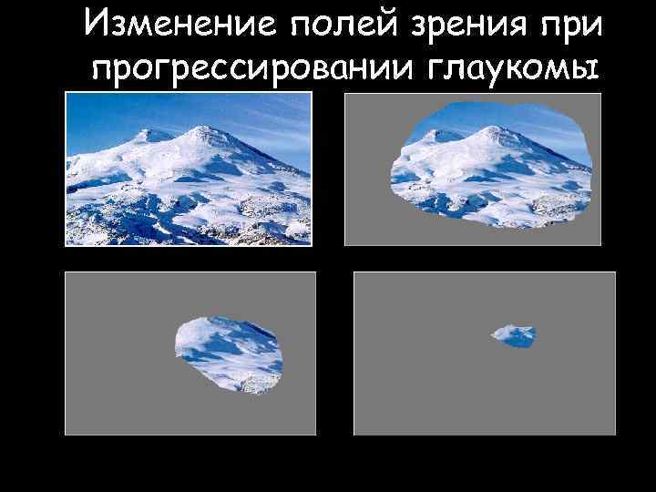 Изменение полей зрения при прогрессировании глаукомы 