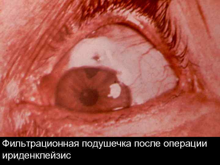 Фильтрационная подушечка после операции ириденклейзис 