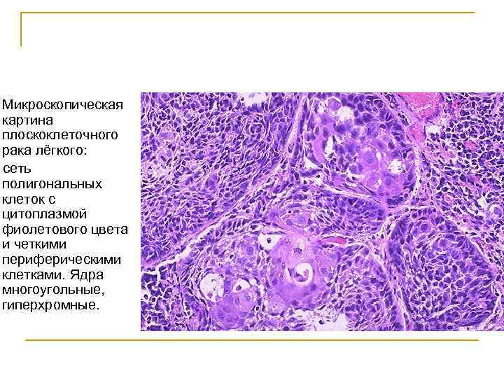 Микроскопическая картина плоскоклеточного рака лёгкого: сеть полигональных клеток с цитоплазмой фиолетового цвета и четкими