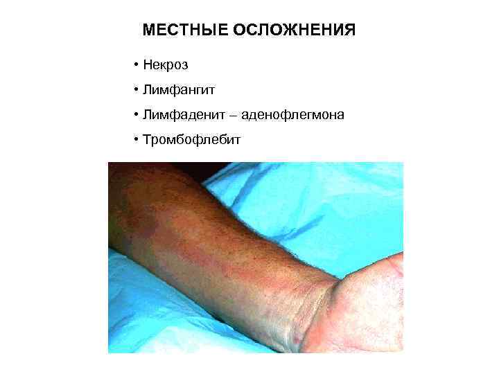МЕСТНЫЕ ОСЛОЖНЕНИЯ • Некроз • Лимфангит • Лимфаденит – аденофлегмона • Тромбофлебит 
