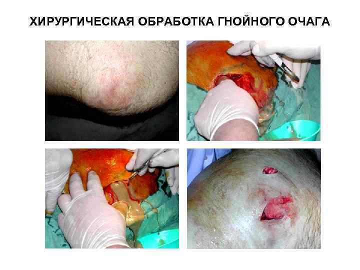 ХИРУРГИЧЕСКАЯ ОБРАБОТКА ГНОЙНОГО ОЧАГА 