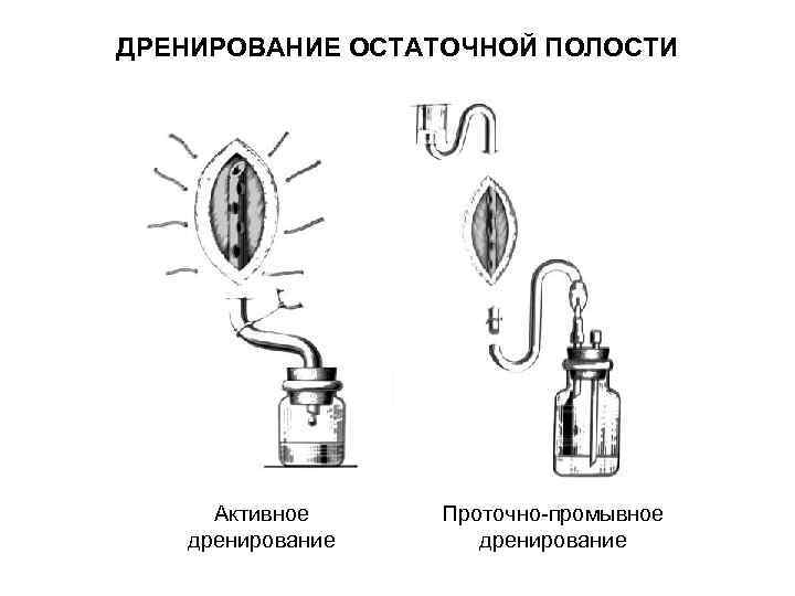 Дренирование ран презентация