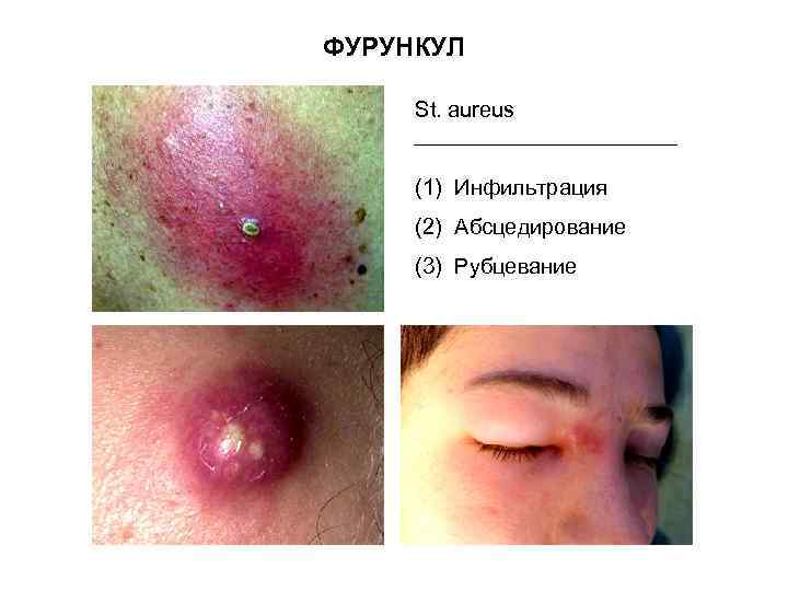 ФУРУНКУЛ St. aureus (1) Инфильтрация (2) Абсцедирование (3) Рубцевание 