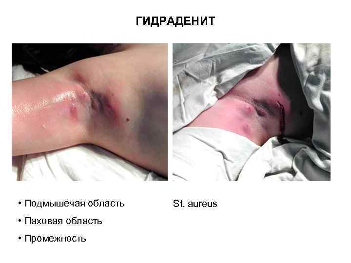 ГИДРАДЕНИТ • Подмышечая область • Паховая область • Промежность St. aureus 