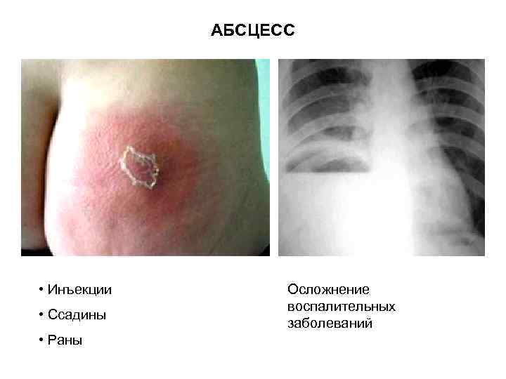 АБСЦЕСС • Инъекции • Ссадины • Раны Осложнение воспалительных заболеваний 