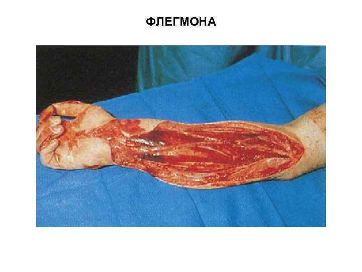 ФЛЕГМОНА 
