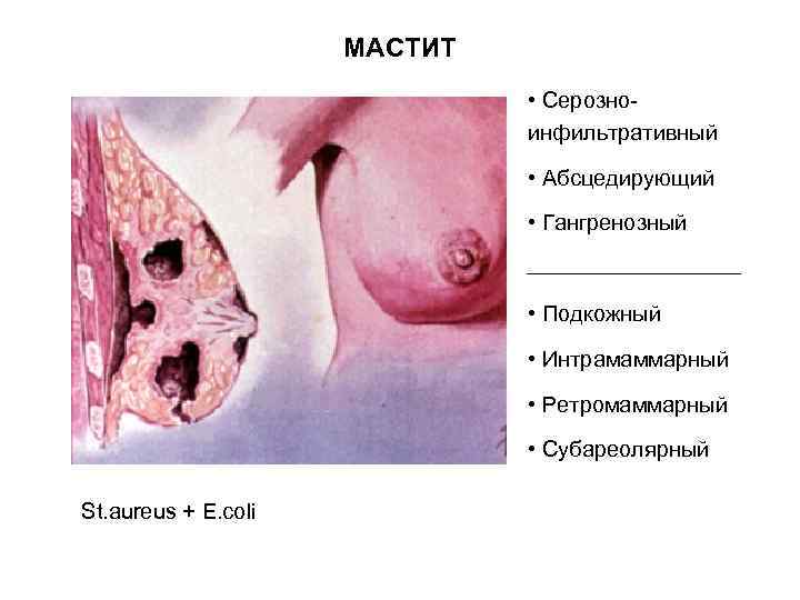 МАСТИТ • Серозноинфильтративный • Абсцедирующий • Гангренозный • Подкожный • Интрамаммарный • Ретромаммарный •