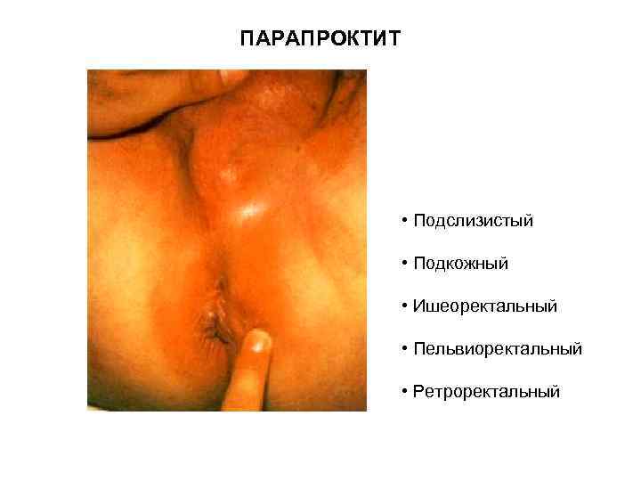 ПАРАПРОКТИТ • Подслизистый • Подкожный • Ишеоректальный • Пельвиоректальный • Ретроректальный 