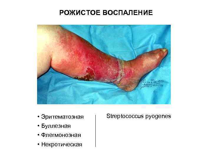 РОЖИСТОЕ ВОСПАЛЕНИЕ • Эритематозная • Буллезная • Флегмонозная • Некротическая Streptococcus pyogenes 