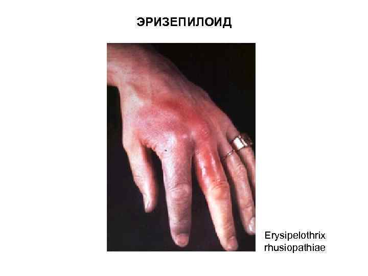 ЭРИЗЕПИЛОИД Erysipelothrix rhusiopathiae 