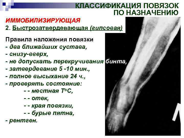 КЛАССИФИКАЦИЯ ПОВЯЗОК ПО НАЗНАЧЕНИЮ ИММОБИЛИЗИРУЮЩАЯ 2. Быстрозатвердевающая (гипсовая) Правила наложения повязки - два ближайших