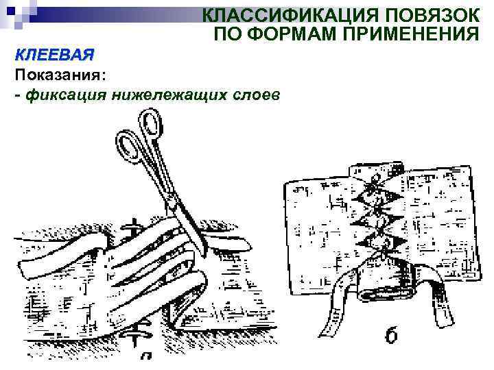 КЛАССИФИКАЦИЯ ПОВЯЗОК ПО ФОРМАМ ПРИМЕНЕНИЯ КЛЕЕВАЯ Показания: - фиксация нижележащих слоев 