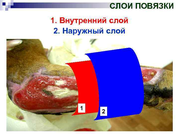 СЛОИ ПОВЯЗКИ 1. Внутренний слой 2. Наружный слой 1 2 