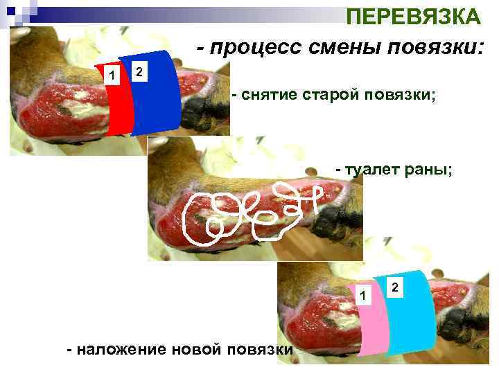 ПЕРЕВЯЗКА - процесс смены повязки: 1 2 - снятие старой повязки; - туалет раны;