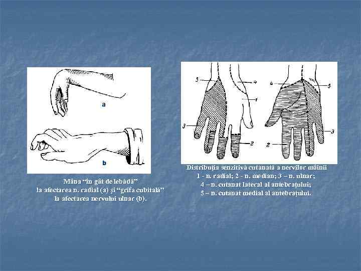 a b Mâna “în gât de lebădă” la afectarea n. radial (a) şi “grifa