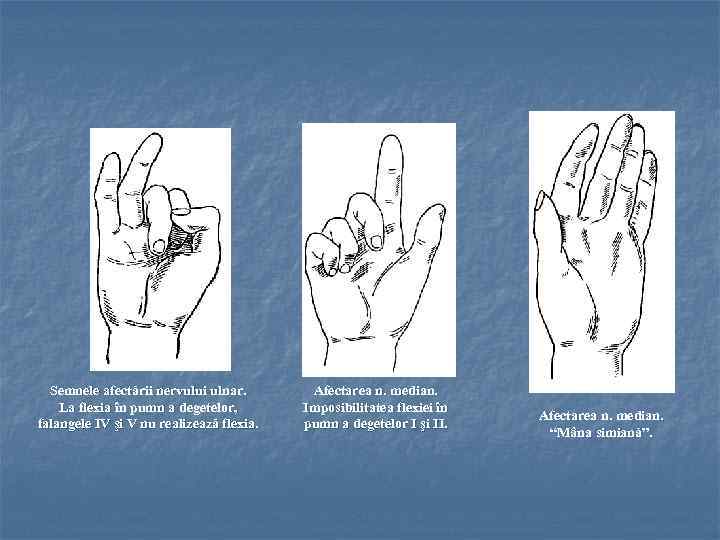 Semnele afectării nervului ulnar. La flexia în pumn a degetelor, falangele IV şi V